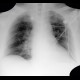 Atelectasis of right upper lobe of lung, resolved: X-ray - Plain radiograph